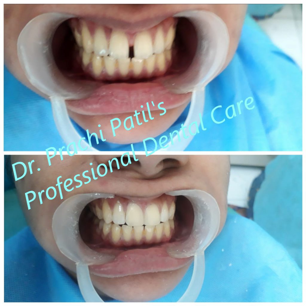 Diastema closure with composite fillings for better aesthetics