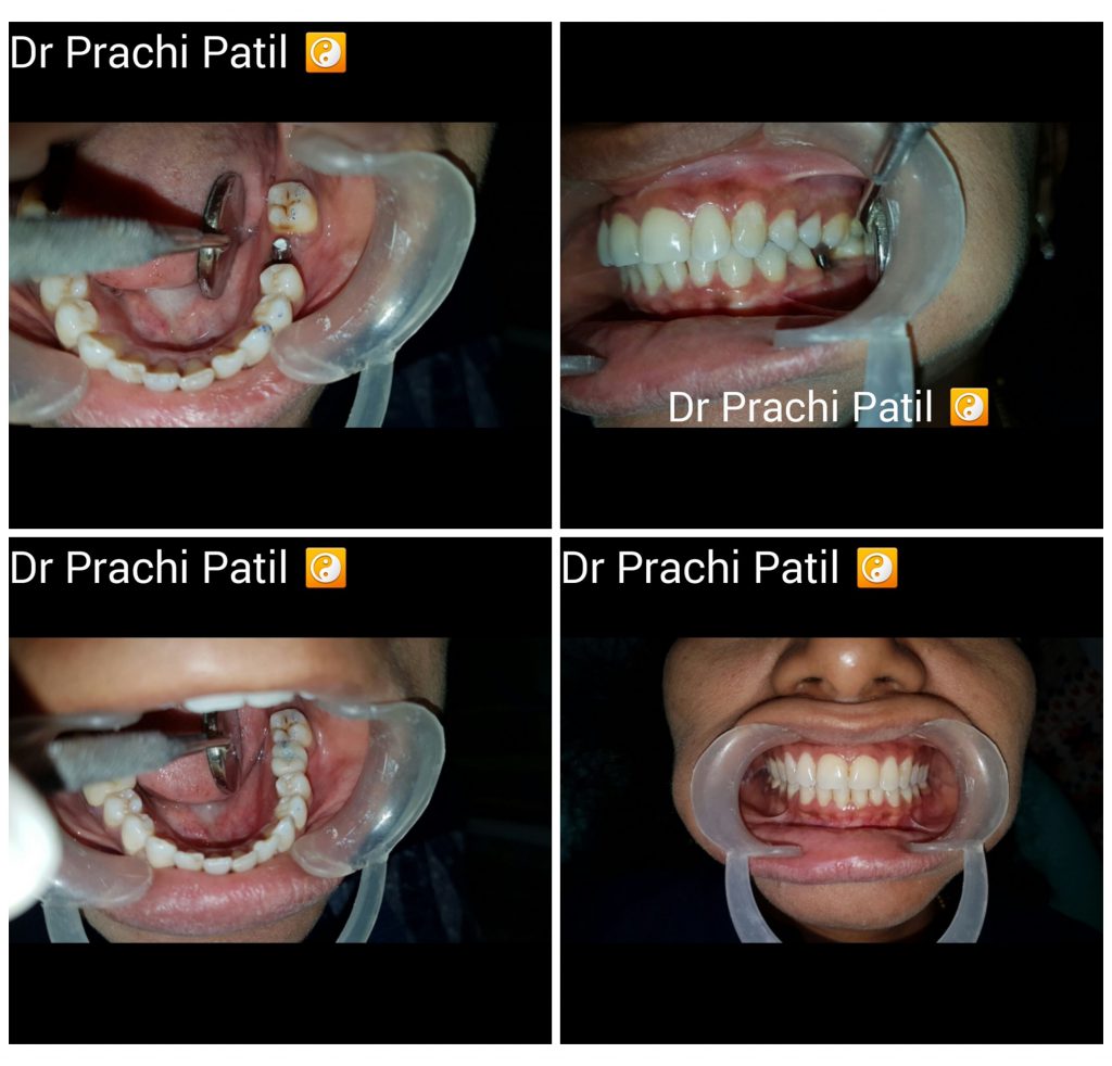 Dental implants at Dr. Prachi Patil's Professional Dental Care, NIBM Road, Pune