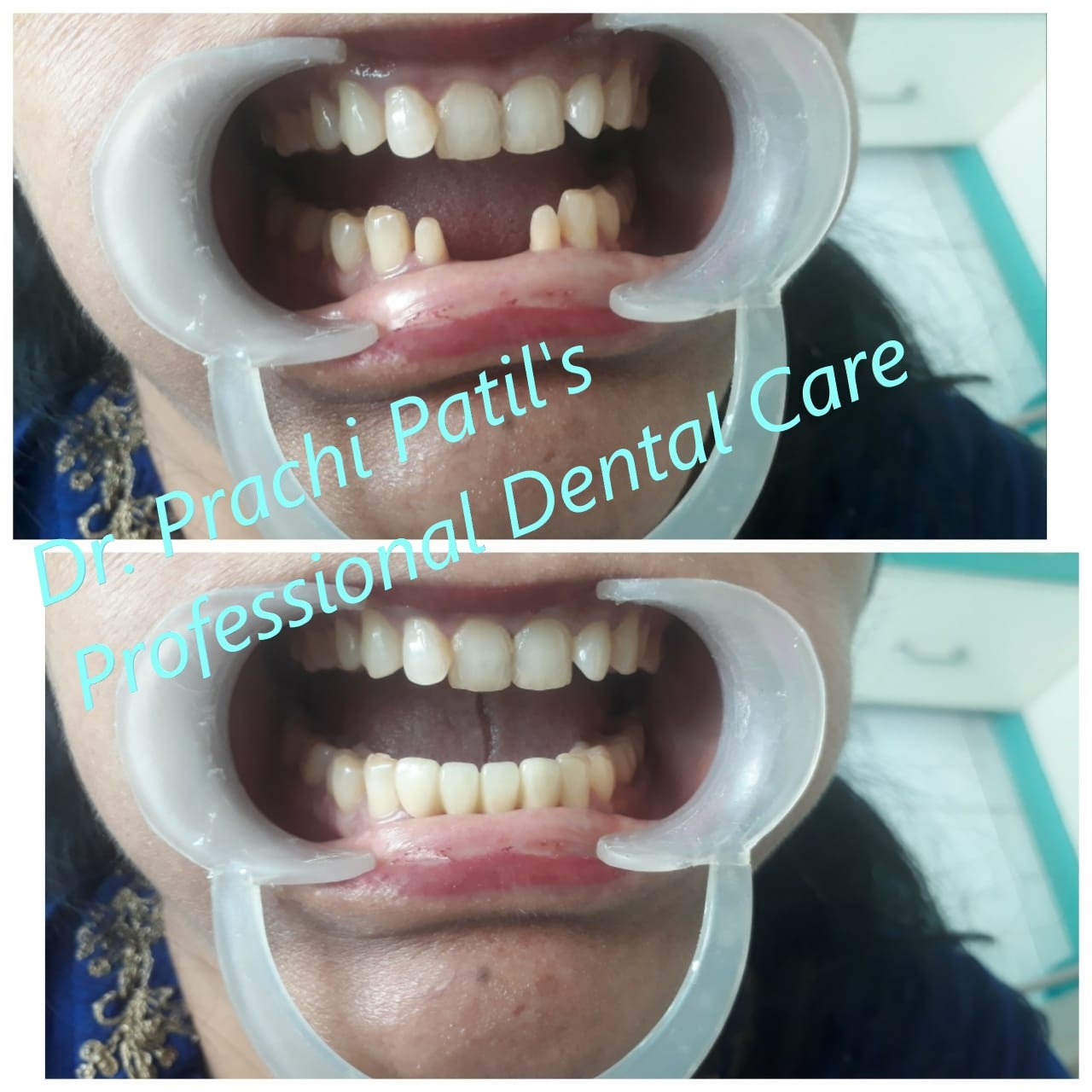 Zirconia Case March 2021 at Dr. Prachi Patil's Professional Dental Care